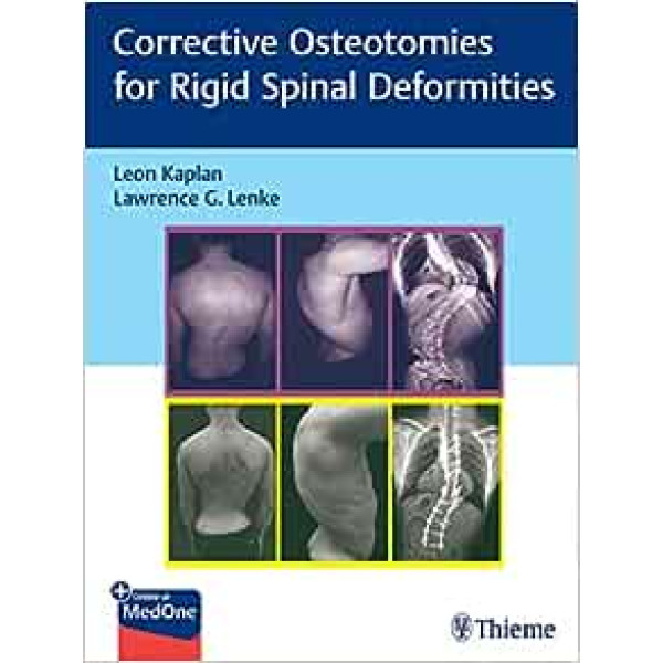 Corrective Osteotomies for Rigid Spinal Deformities Ορθοπεδική