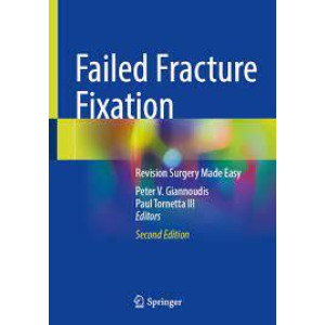 Failed Fracture Fixation Revision Surgery Made Easy Ορθοπεδική