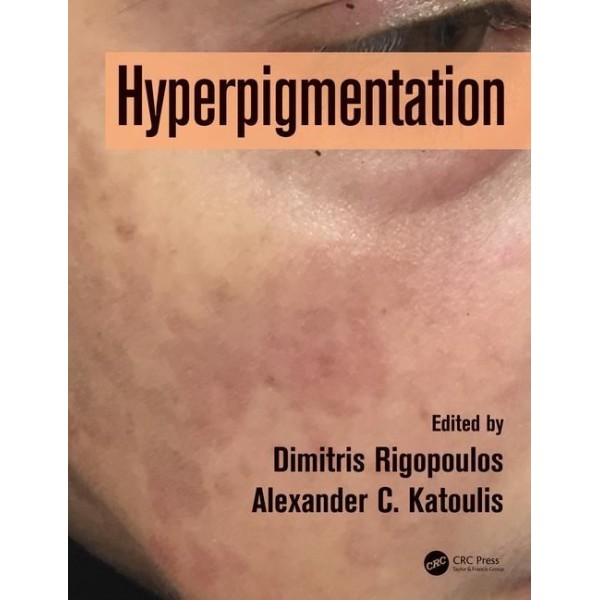 Hyperpigmentation Πλαστική Χειρουργική