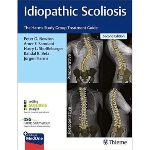 Idiopathic Scoliosis The Harms Study Group Treatment Guide Ορθοπεδική