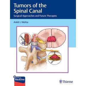 Tumors of the Spinal Canal Surgical Approaches and Future Therapies Νευροχειρουργική