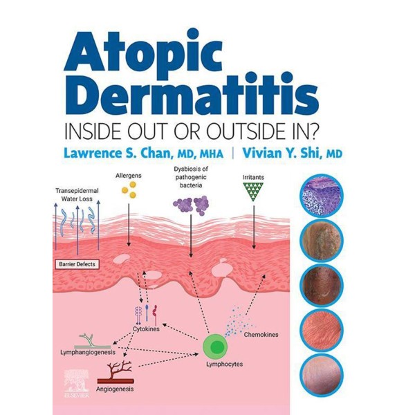 Atopic Dermatitis: Inside Out or Outside In Δερματολογία