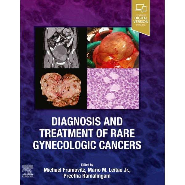 Diagnosis and Treatment of Rare Gynecologic Cancers Μαιευτική-Γυναικολογία
